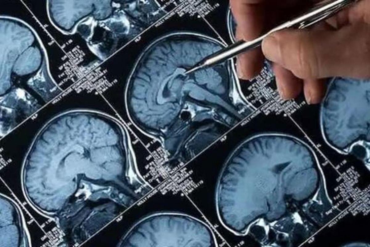 نخستین فناوری نقشه‌برداری مغز در هند رونمایی شد