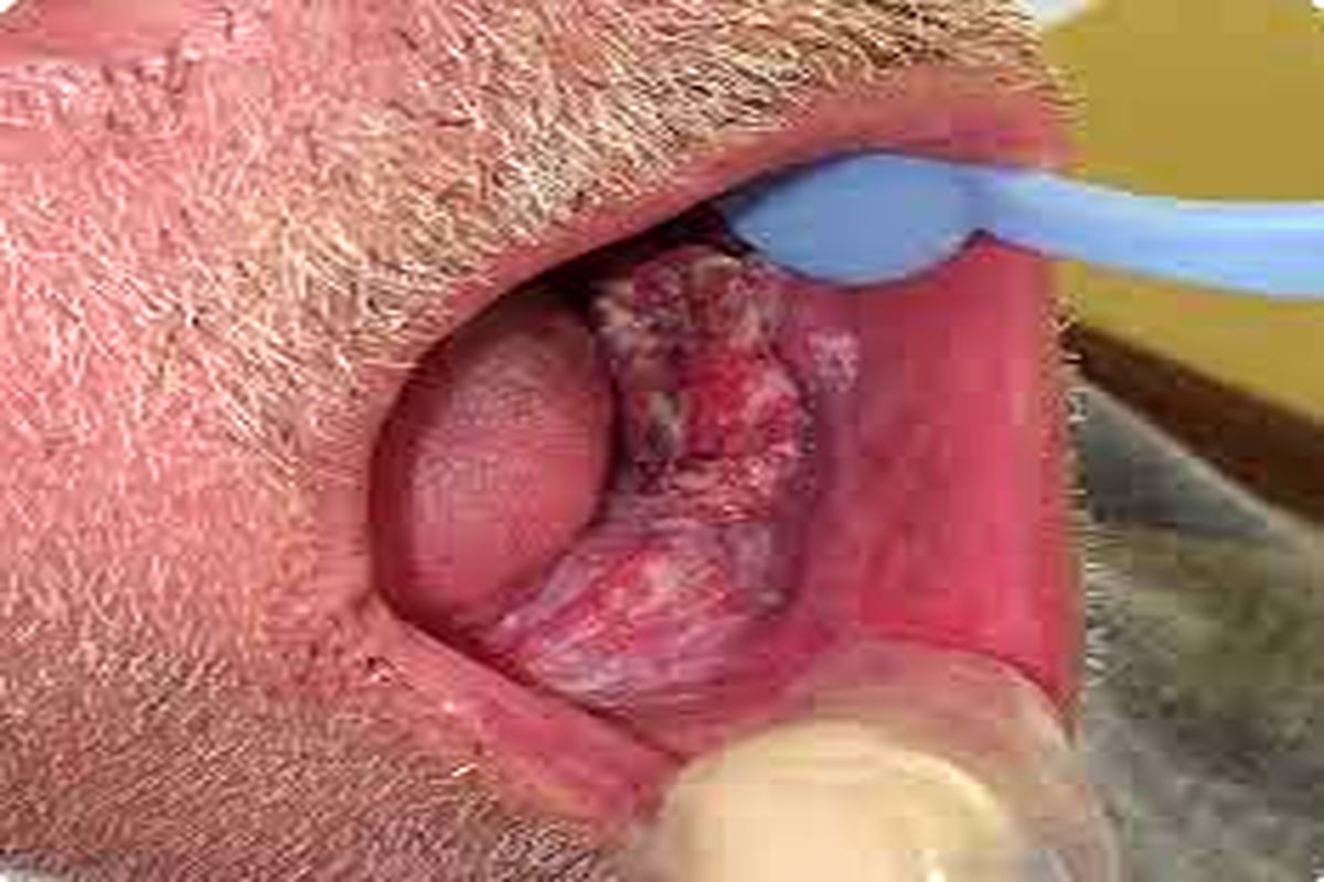 علائم و روش های پیشگیری از سرطان دهان! 